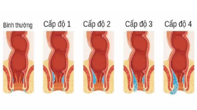 Mô tả 4 cấp độ của trĩ nội - trĩ nội có cần phẫu thuật