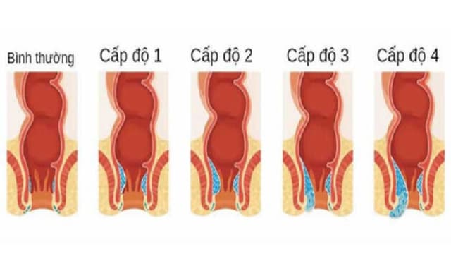 Trĩ nội có cần phẫu thuật, điều trị cần chú ý điều gì?