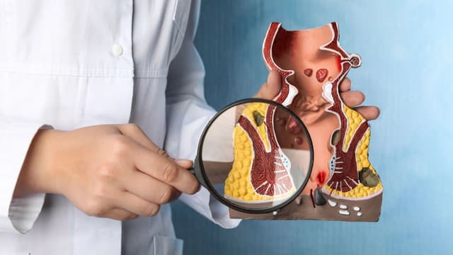 Trĩ nội sa độ 3: Triệu chứng, chẩn đoán và phương pháp điều trị hiệu quả nhất