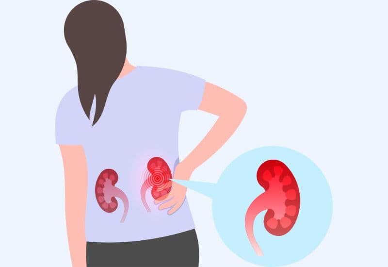 Cách nhận biết sớm giãn đài bể thận