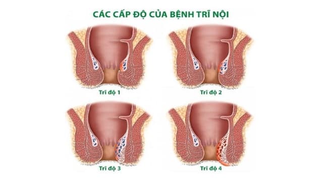 Triệu chứng trĩ nội: Nhận biết sớm để điều trị hiệu quả
