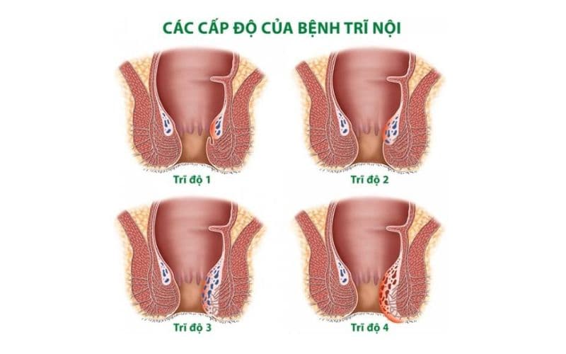 Triệu chứng trĩ nội