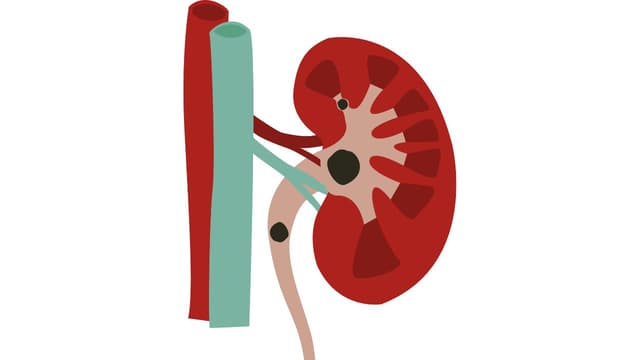 Tại sao sỏi thận dễ gây ứ nước thận? Giải pháp điều trị từ gốc