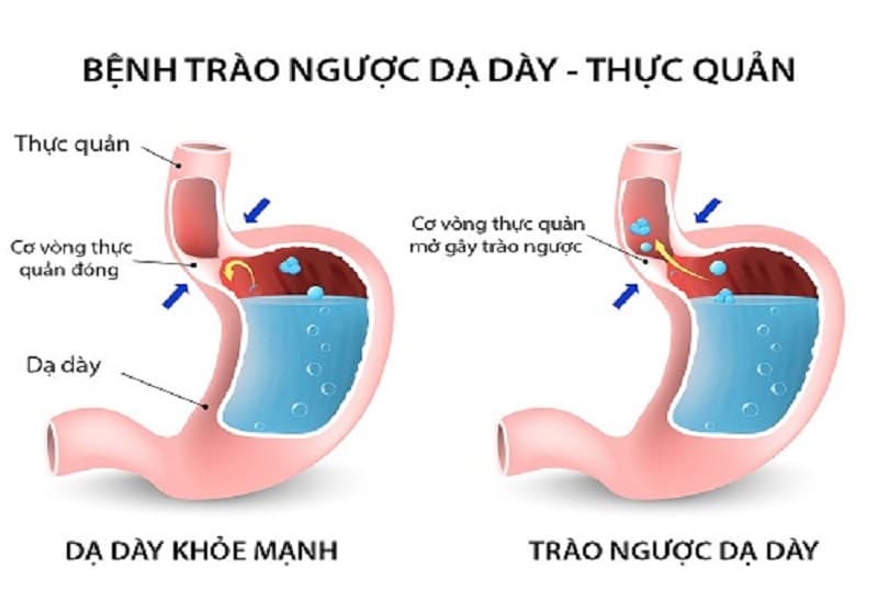 Tình trạng suy yếu cơ thắt thực quản dưới (LES) dẫn đến trào ngược