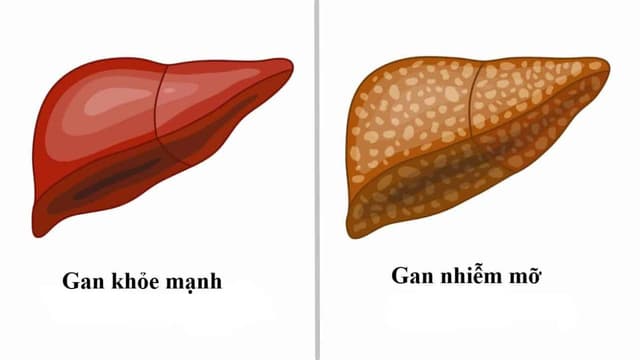Gan nhiễm mỡ không do rượu: Nguyên nhân và cách kiểm soát