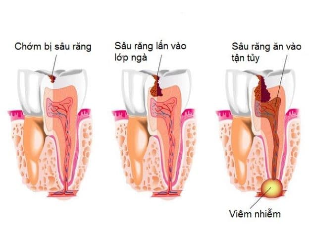 Sâu răng, sâu ngà hay sâu cổ răng được gọi chung là bệnh sâu răng.