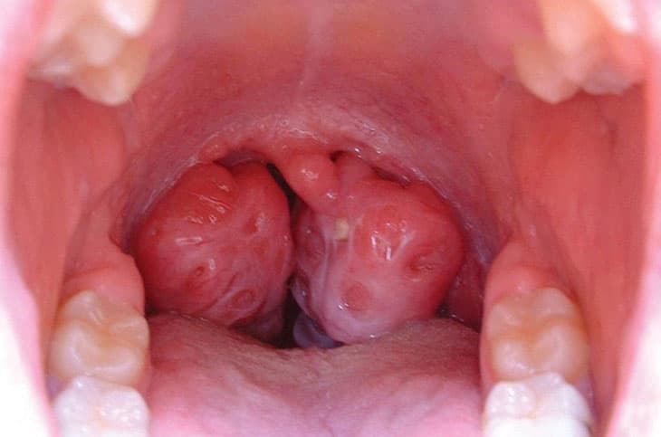 Viêm amidan quá phát