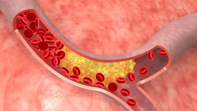 Bệnh mỡ máu: Nguyên nhân và nguy cơ tiềm ẩn