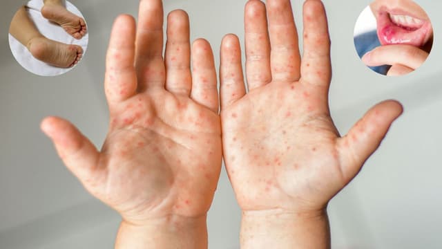 Nhận biết để phòng ngừa bệnh tay chân miệng ở trẻ sơ sinh