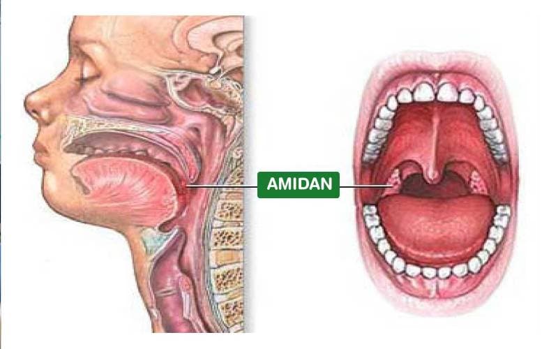 Bệnh viêm amidan như thế nào