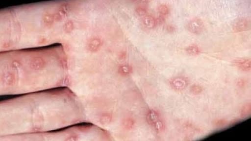 Điều trị bệnh xã hội tại Bệnh viện ĐKQT Thu Cúc TCI