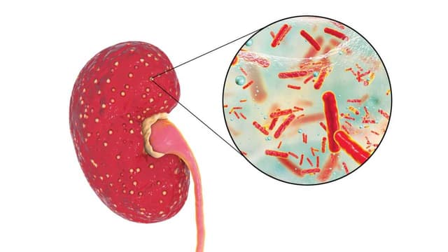 Mức độ nguy hiểm khi bị thận ứ nước nhiễm khuẩn