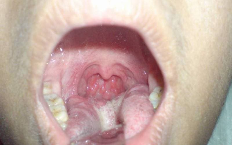 Biểu hiện viêm họng hạt thế nào