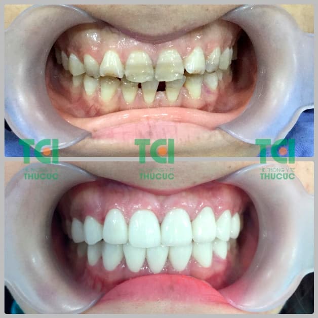 bọc răng sứ cho người răng vỡ, ố màu