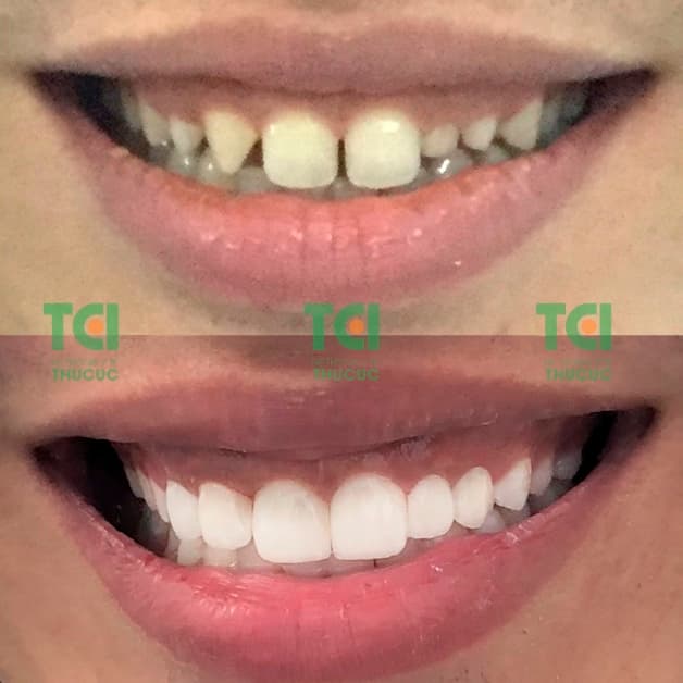 bọc răng sứ cho người răng thưa