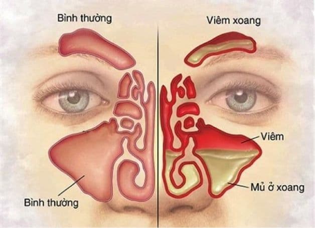 Viêm xoang là tình trạng lớp niêm mang trong mũi bị virus, vi khuẩn tấn công, gây viêm nhiễm.