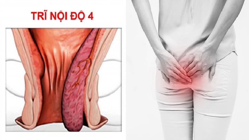 trĩ nội độ 4 có thể gây biến chứng nguy hiểm như tắc mạch