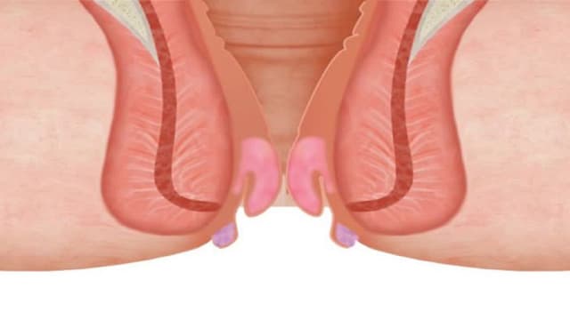 Các cấp độ trĩ nội và các phương pháp chữa trĩ nội hiệu quả