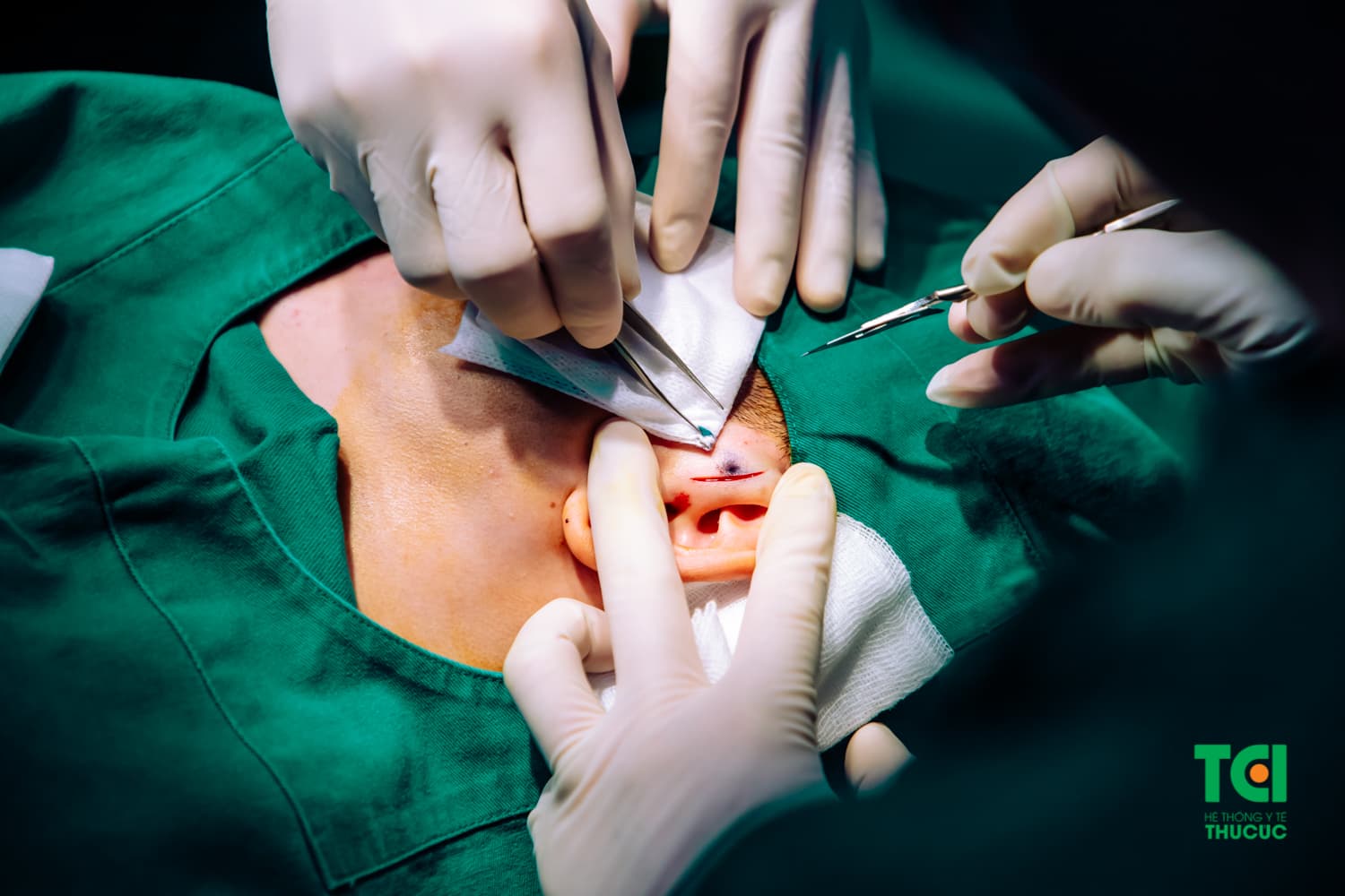 Phẫu thuật lấy đường rò luân nhĩ