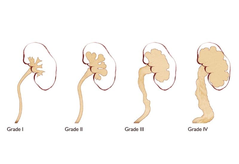 Các cấp độ ứ nước thận