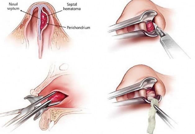 Minh họa phẫu thuật cắt cuốn mũi