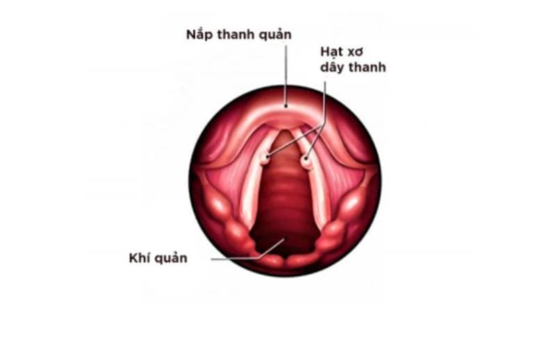 Cắt hạt xơ dây thanh kiêng nói bao lâu hả bác sĩ