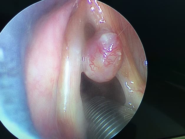 Hình anh một polyp dây thanh