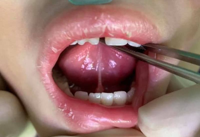Cắt thắng lưỡi cho bé là thủ thuật nhanh chóng, dễ thực hiện và không ảnh hưởng nhiều đến việc ăn uống của trẻ