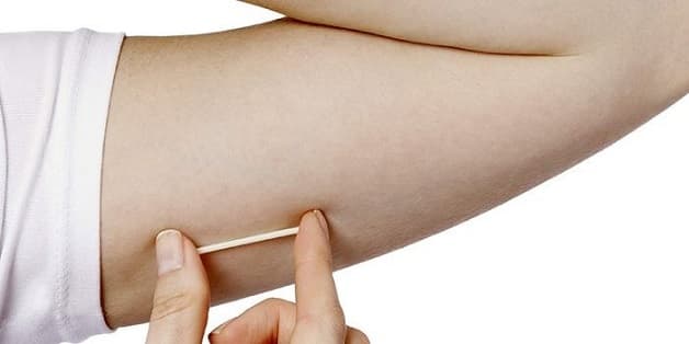 cấy que tránh thai