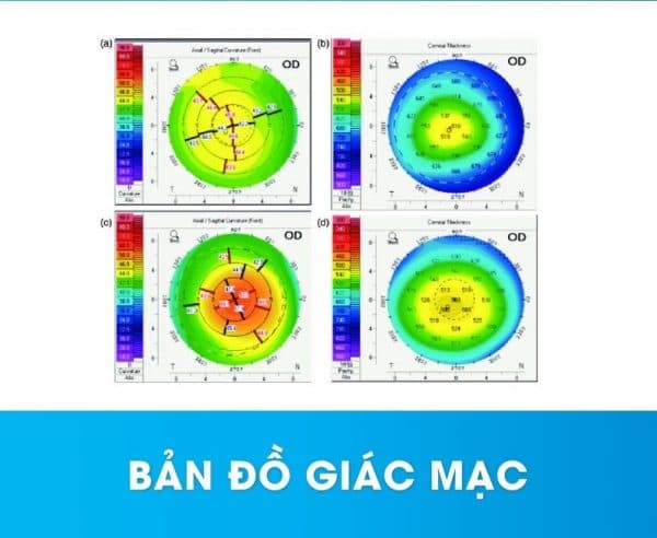 chụp bản đồ giác mạc