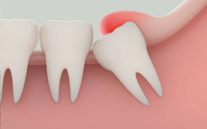 Có nên nhổ răng khôn không nếu đã nhiều tuổi