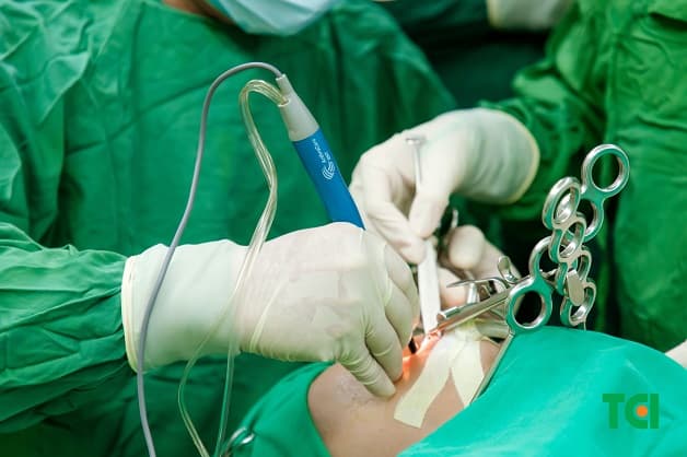 Cận cảnh sử dụng máy Coblator công nghệ Plasma trong phòng mổ