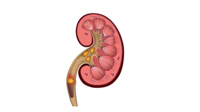 Giãn đài bể thận 15mm do sỏi thận nguy hiểm không, cách điều trị