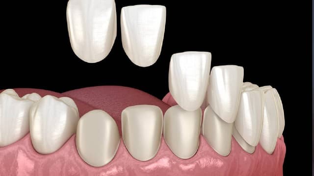 Dán veneer răng – Giải pháp thẩm mỹ cho nụ cười
