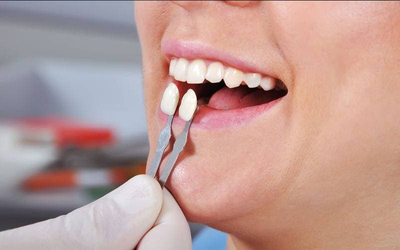 dán veneer răng đắt không