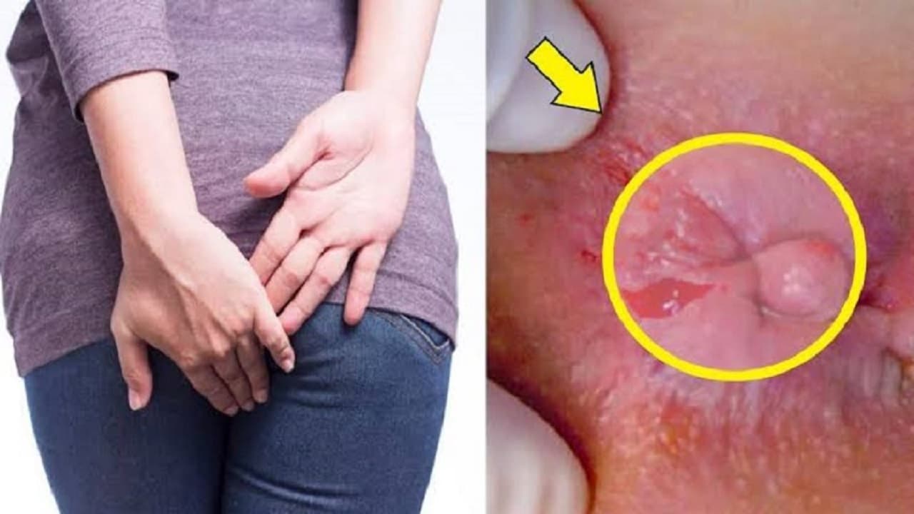 Dấu hiệu của bệnh trĩ ngoại