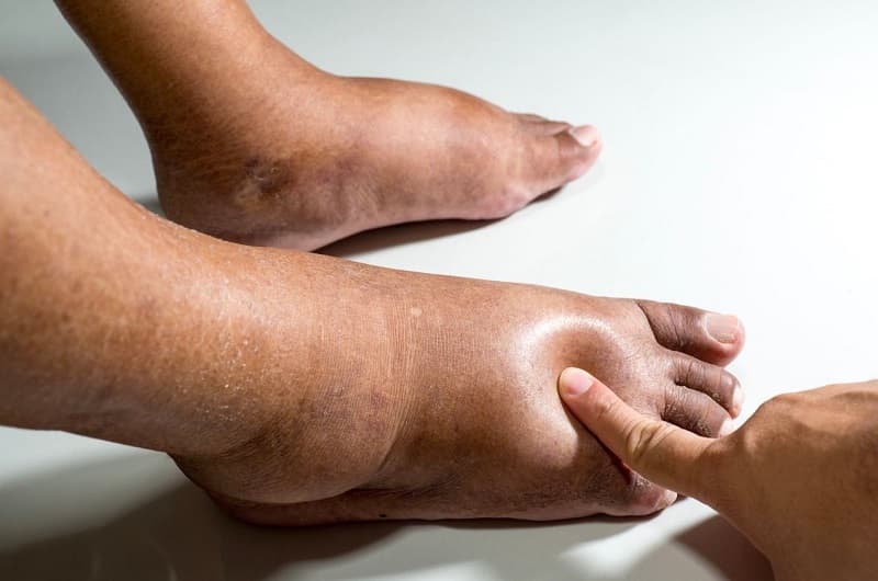 Dấu hiệu bệnh suy tim cần chú ý