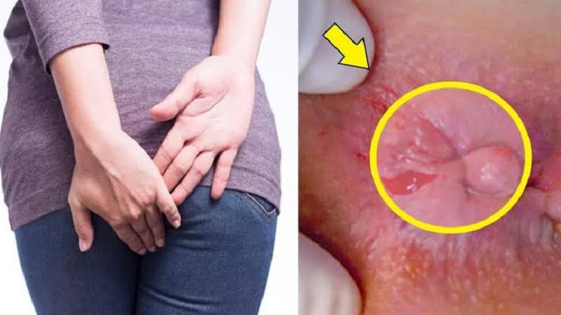 Có nhiều yếu tố gây tăng nguy cơ mắc bệnh trĩ ngoại