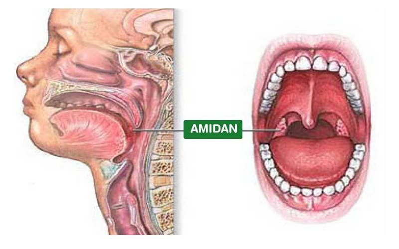 Điều trị viêm amidan bằng cách nào