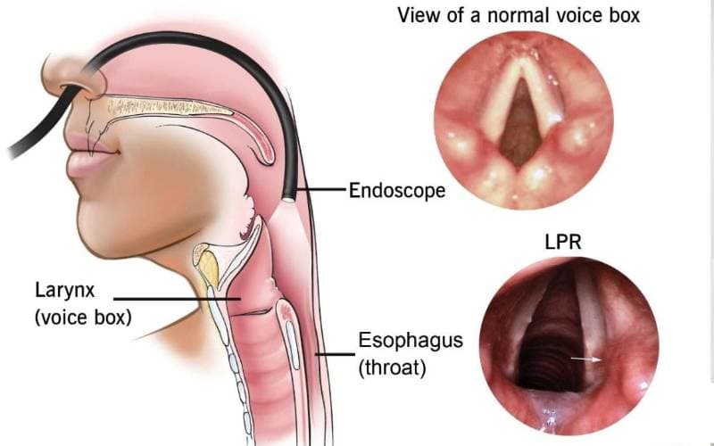 điều trị viêm thanh quản được không