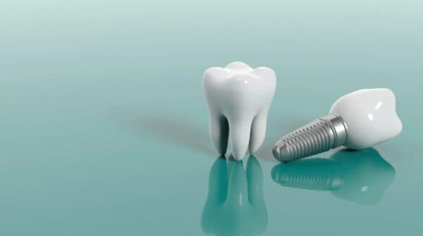 Implant nha khoa là phương pháp trồng răng giả tiên tiến, sử dụng trụ implant cấy ghép vào xương hàm.