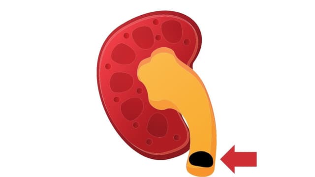 Giãn đài bể thận và niệu quản trái do sỏi niệu quản 1/3 trên