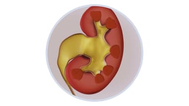 Hậu quả nguy hiểm ứ nước thận độ 3 do sỏi kéo dài không điều trị