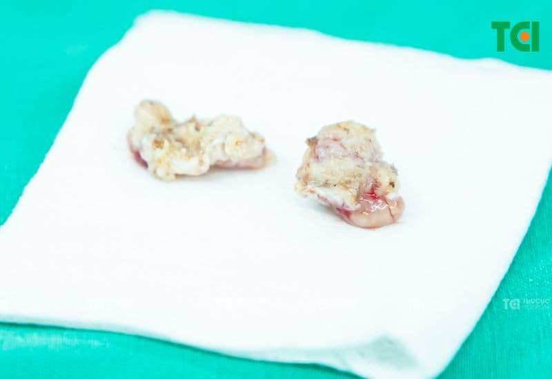 Giá nạo VA tại Hệ thống Y tế Thu Cúc TCI dao động trong khoảng 17.600.000 đến 22.000.000 VNĐ, không bao gồm chi phí khám lâm sàng và khám cận lâm sàng cũng như chi phí thuốc và vật tư.