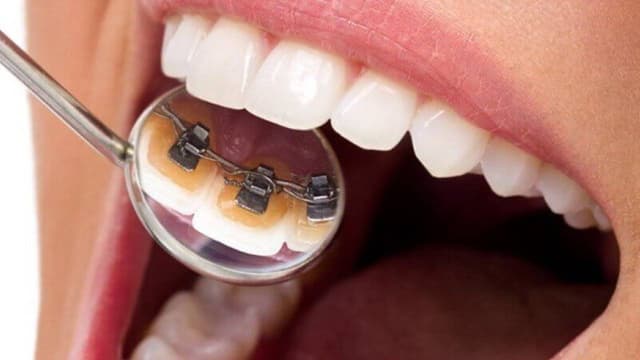 Nẹp răng mặt trong – Chỉnh nha kín đáo cho nụ cười hoàn hảo