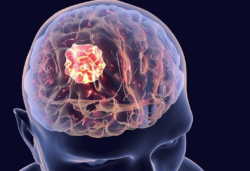 Động kinh xảy ra ở người lớn do đâu?