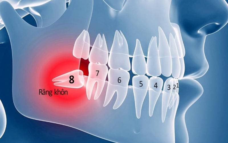 Liệu Nhổ 4 răng khôn cùng lúc có sao không