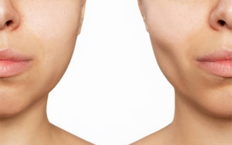 Niềng răng bị hóp má là gì