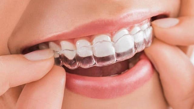 Niềng răng invisalign và những điều cần biết trước khi thực hiện