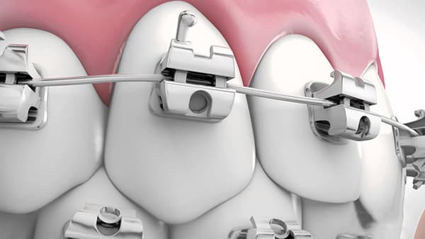 Niềng răng mắc cài tự động có điểm nổi bật là khắc phục được những sự cố do dây chun gây ra